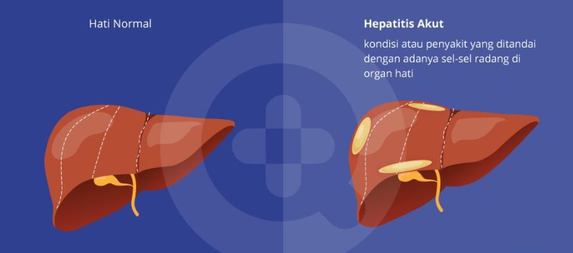 Kemenkes Belum Bisa Identifikasi Asal 3 Kasus Hepatitis Akut di Indonesia