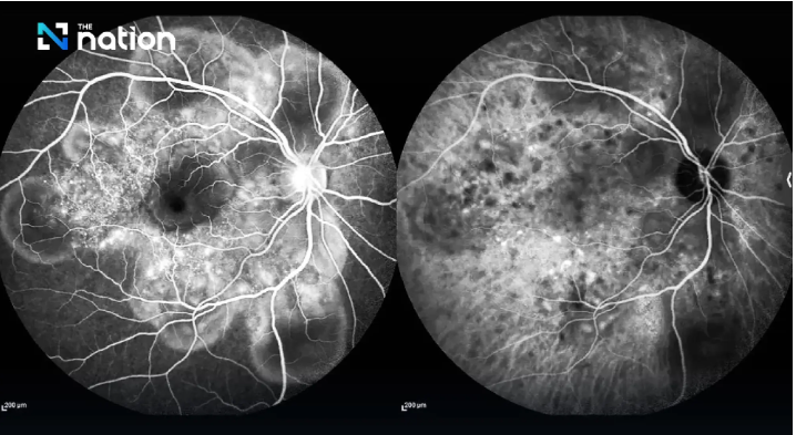 Thailand Juara 3 Fotografi Oftalmik Mata Internasional